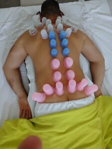 cupping